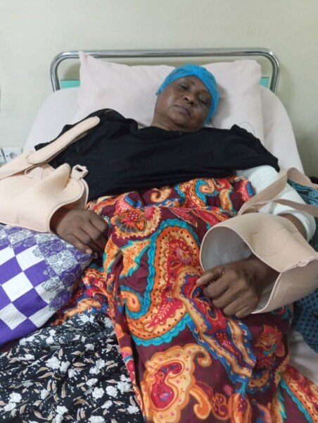 المحامية بمشفى الضمان بمروي.. وتبدو آثار الكسور بيديها